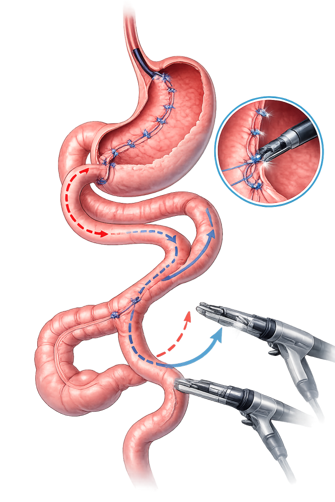 Bipartición Intestinal